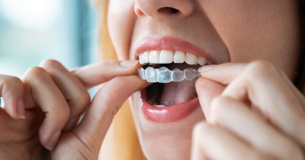 A close-up of a woman opening her mouth and inserting a clear, plastic, orthodontic aligner onto her teeth.