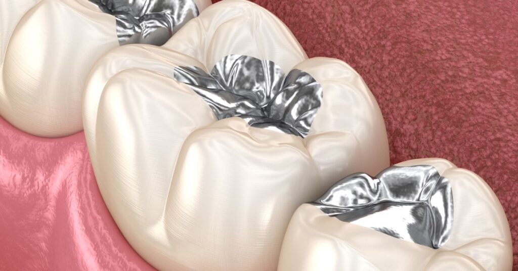 An extreme close-up of a person's gums and teeth. The middle of the teeth are filled with mercury cavity fillings.