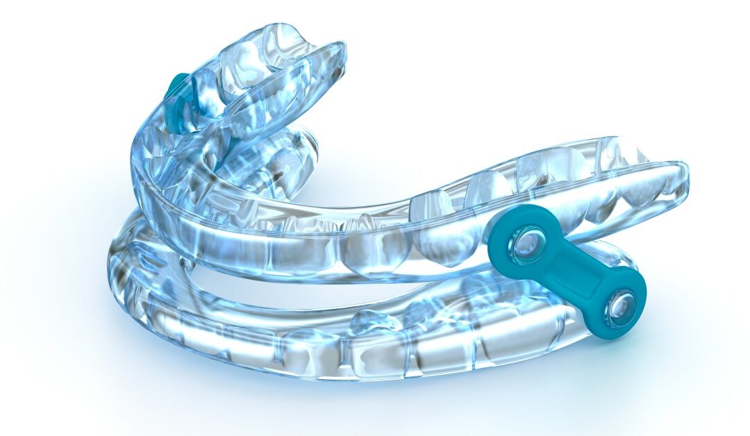 A light blue oral appliance therapy device for sleep apnea is positioned in the center of frame against a white background.