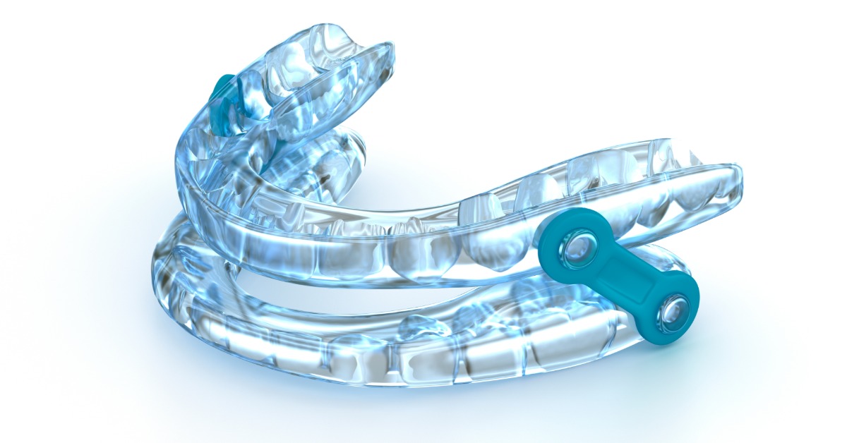 A close-up of a blue custom oral appliance used for sleep apnea treatment. The device is positioned on a white background.