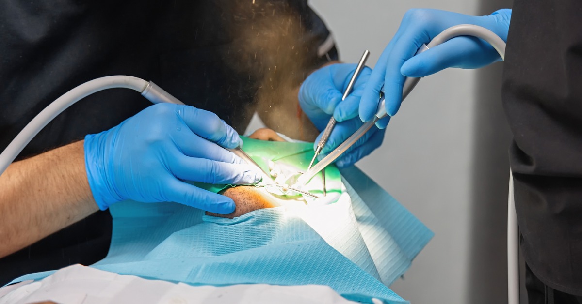 A patient lies down with a blue paper covering their face as a dentist removes an old filling from the patient's mouth.