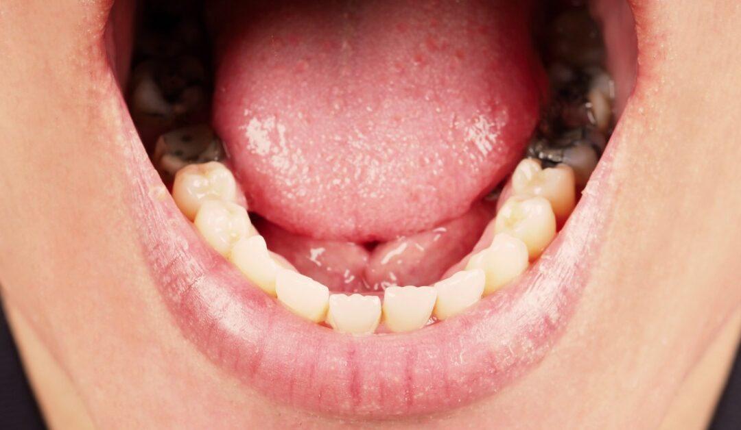 An extreme close-up of a person's mouth open wide. The two lower teeth on both sides of the mouth have silver fillings.