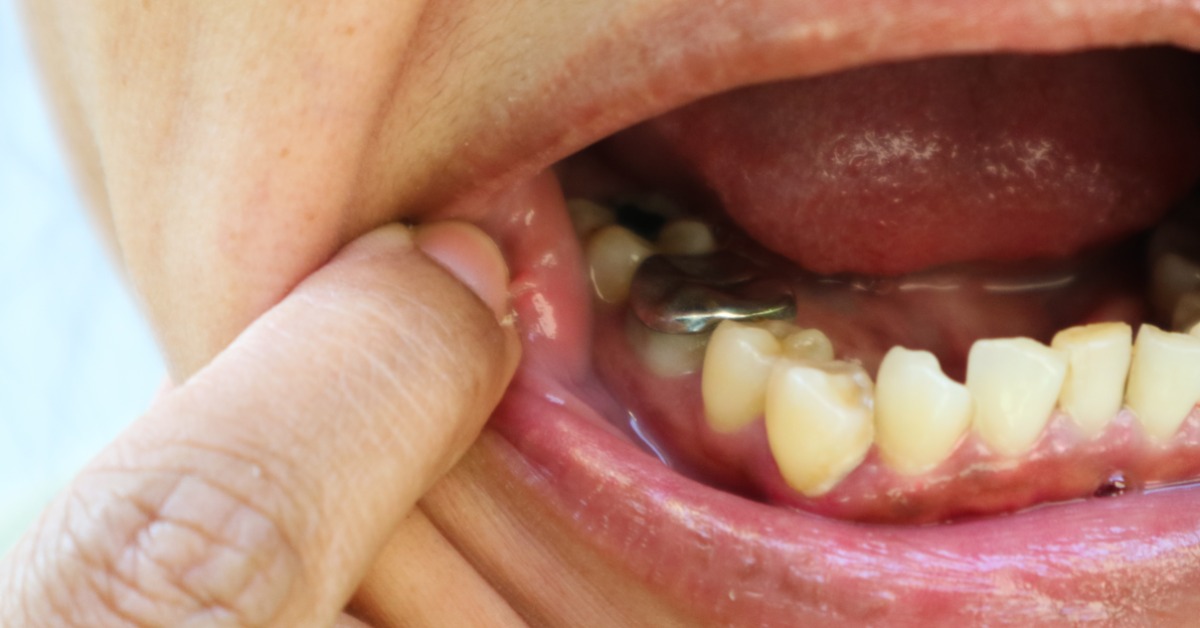 A person pulls their lip to the side to reveal their teeth. The top of a bottom tooth has a large amalgam filling.