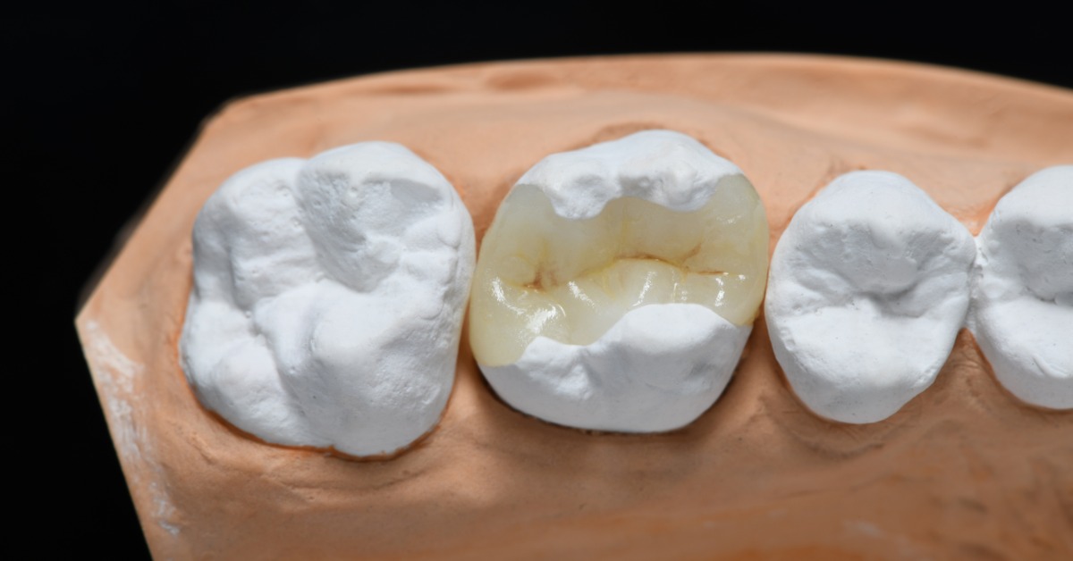 A close-up of a mold of teeth against a black background. One tooth has a white dental inlay fitted onto the center.