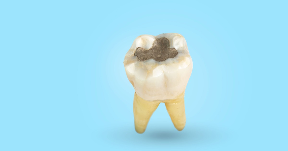 A full tooth positioned upright against a blue background. The center of the tooth is gray with a metal filling.