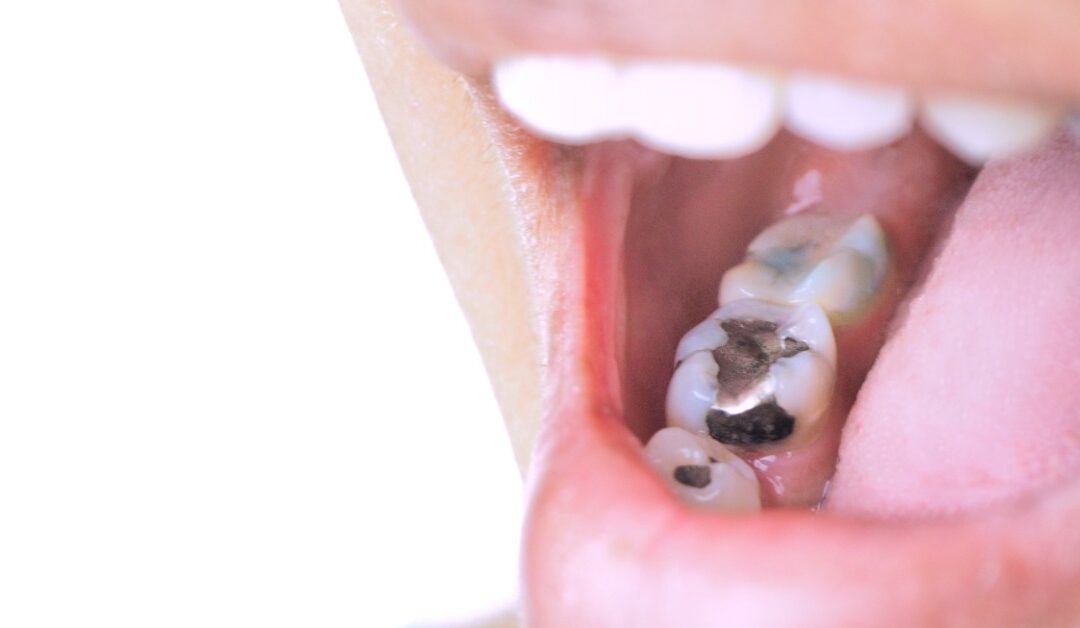 A close-up of a person opening their mouth. One molar has a silver filling in the center and side of the tooth.