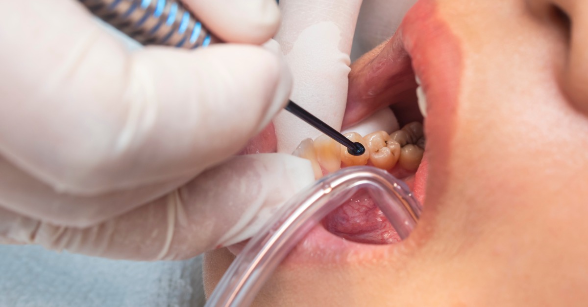 An extreme close-up of a person's open mouth as a dentist's gloved hands insert a filling into a tooth.