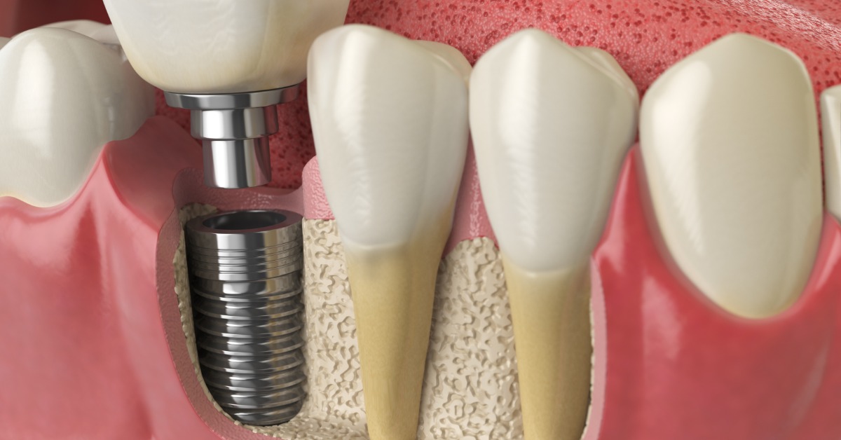 A 3D dental illustration that shows teeth, roots, gums, and a metal implant alongside the natural teeth.