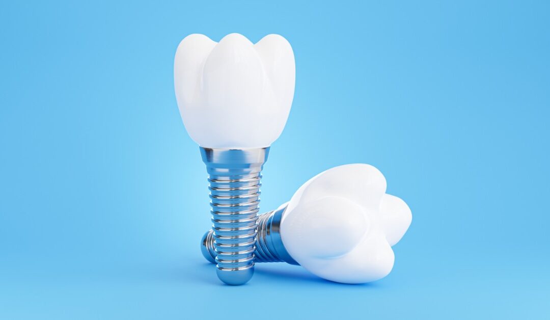 The Different Kinds of Dental Implants Explained