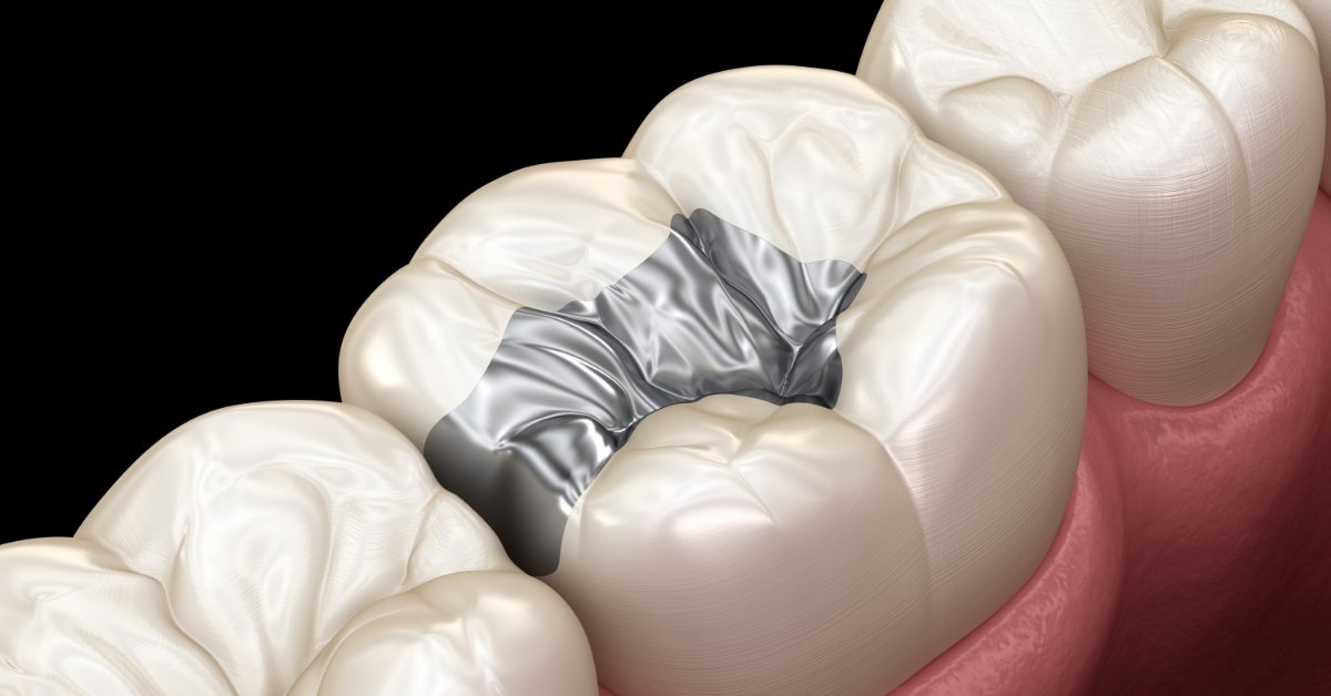 A 3D illustration showing a silver dental crown being positioned above a molar among several white teeth.