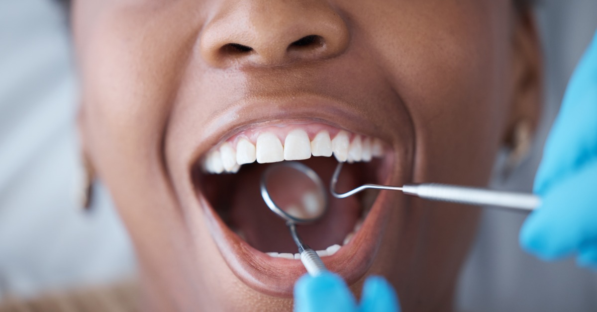 An extreme close-up of a person holding their mouth open as a dentist flosses the patient's top row of teeth.