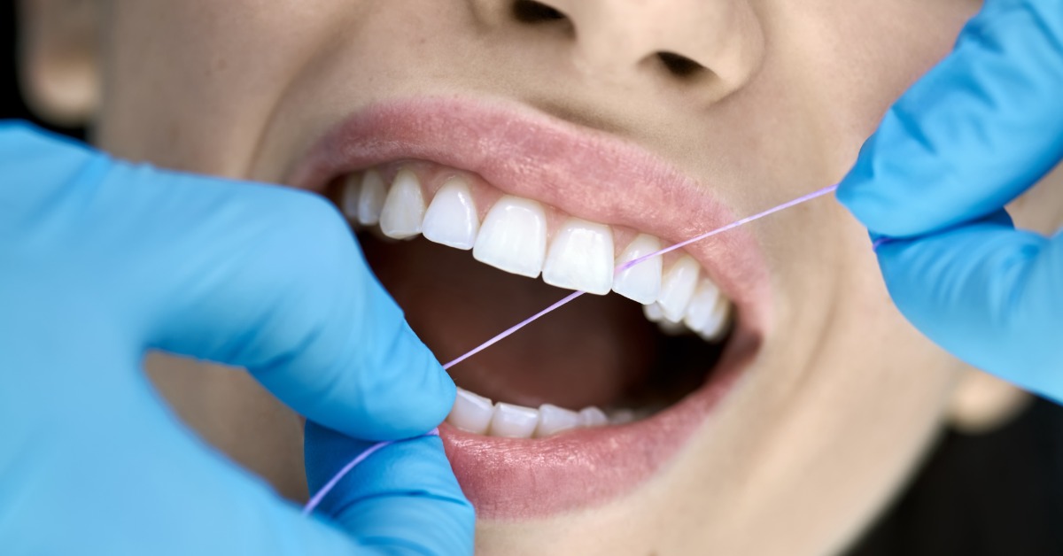 A close-up of a person smiling with their mouth parted as a dentist wearing gloves polishes the patient's front teeth.