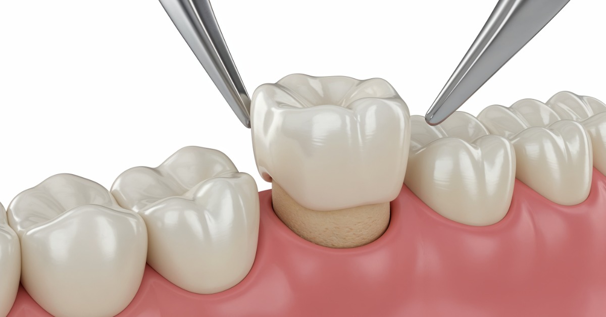A close-up 3D rendering of two metal rods positioning a white dental crown above a prepared tooth stump.