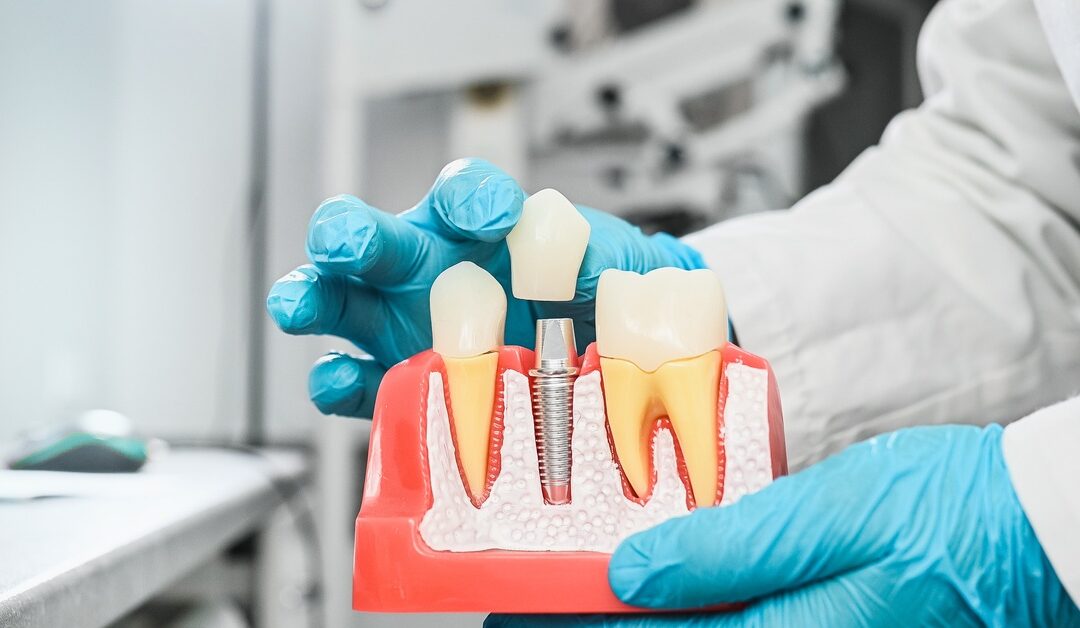 Gloved hands holding a tooth and gum model with a metal dental implant and detached crown in a dental office.