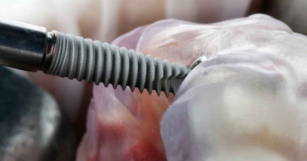 A metal dental implant tool angled toward a blue surgical guide inside a mouth with circular guide openings.