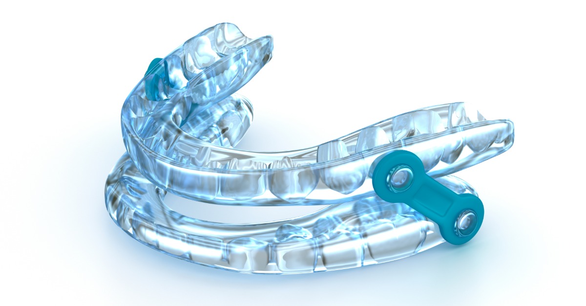 A clear blue oral appliance with upper and lower trays and a teal side connector is sitting isolated on a white surface.