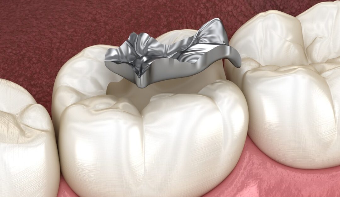 A 3D illustration of molar teeth with a silver crown positioned above one tooth and pink gum tissue below.