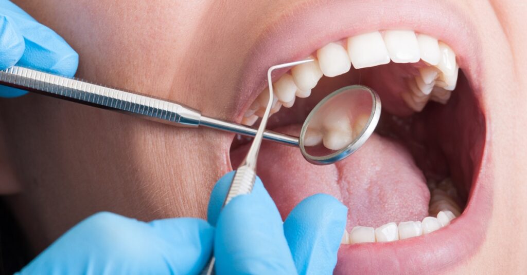 An extreme close-up of a person's mouth as two gloved hands hold a mirror and a dental scraper tool to the teeth.