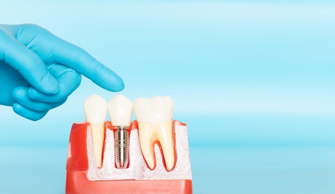A blue-gloved hand is pointing at a dental model of an implant positioned between two natural teeth.
