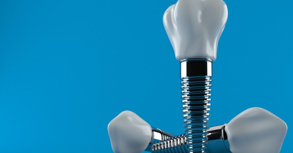 A blue-gloved hand is pointing at a dental model of an implant positioned between two natural teeth.