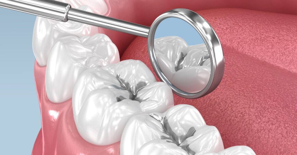 A 3D illustration of white molars with silver fillings positioned in the center of the molars. A mirror reflects the teeth.